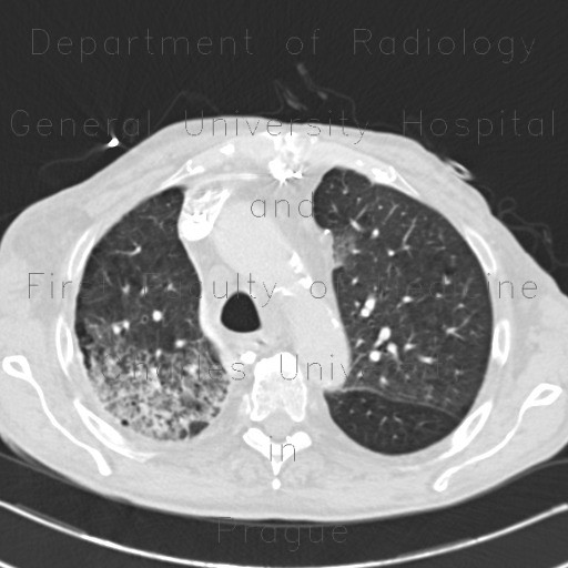 Pneumonia, centrilobular emphysema