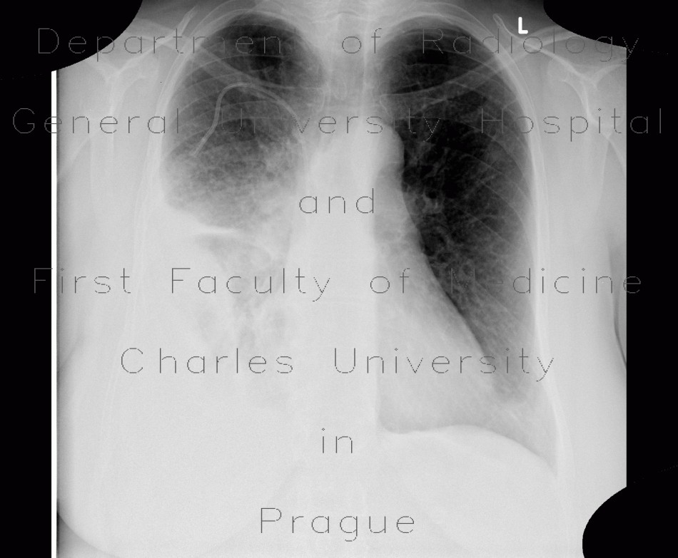 Pneumonia, consolidation