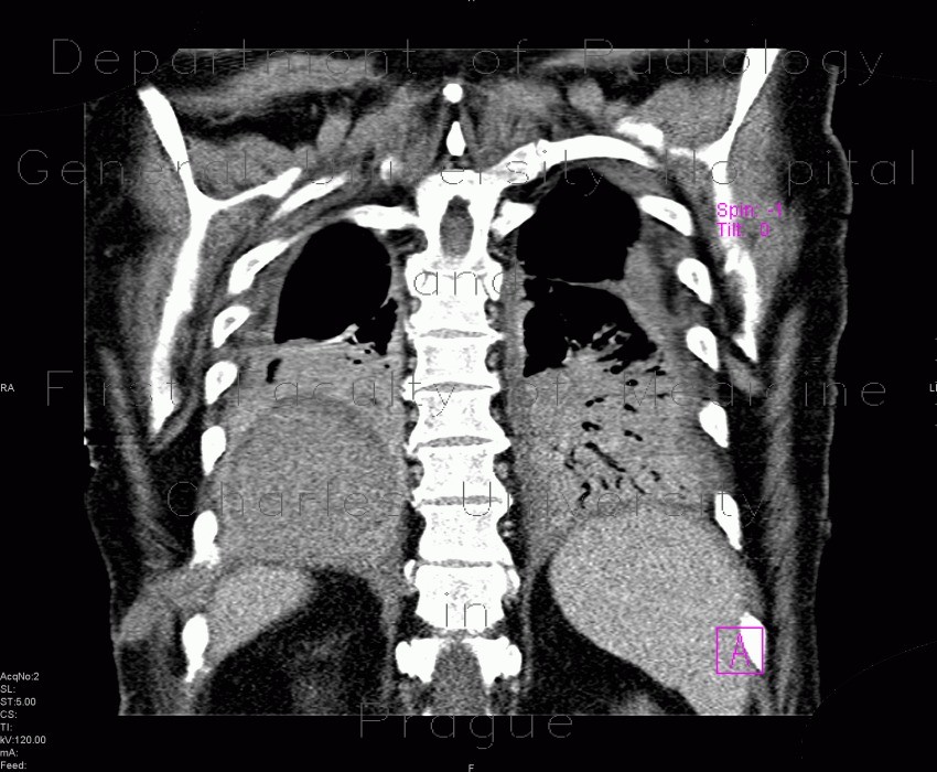 Radiology image - Pneumonia, liquefaction: Thorax, Lung: CT - Computed tomography