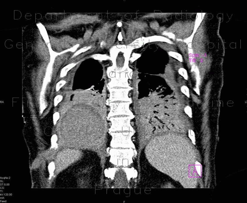 Pneumonia, liquefaction