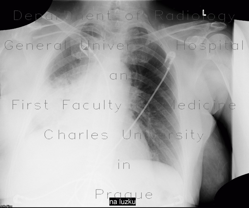 Pneumonia, lobectomy