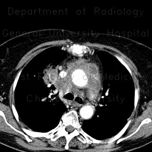 Radiology image - Pneumonia, mediastinitis, mediastinal abscess: Thorax, Lung, Mediastinum and pleural cavity: CT - Computed tomography