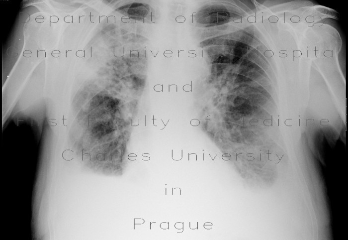 Radiology image - Pneumonia, pleural effusion: Thorax, Lung: X-ray - Plain radiograph