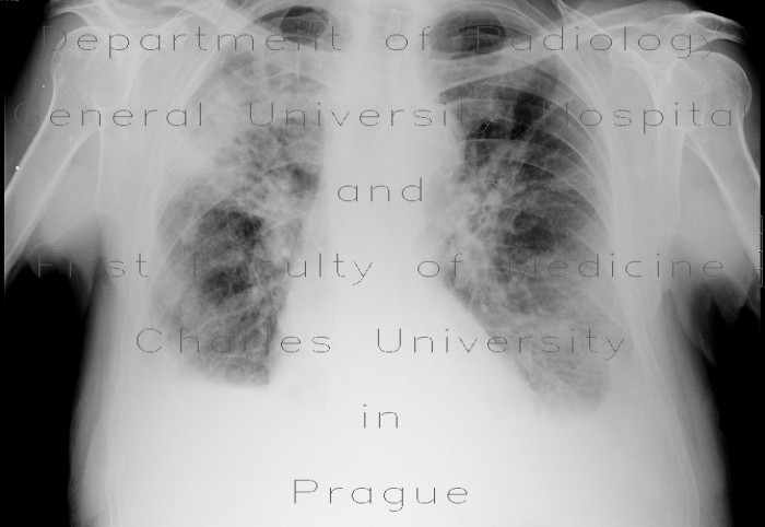 Pneumonia, pleural effusion