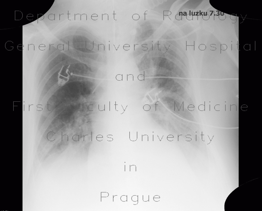 Pneumonia, pleural effusion, correlation