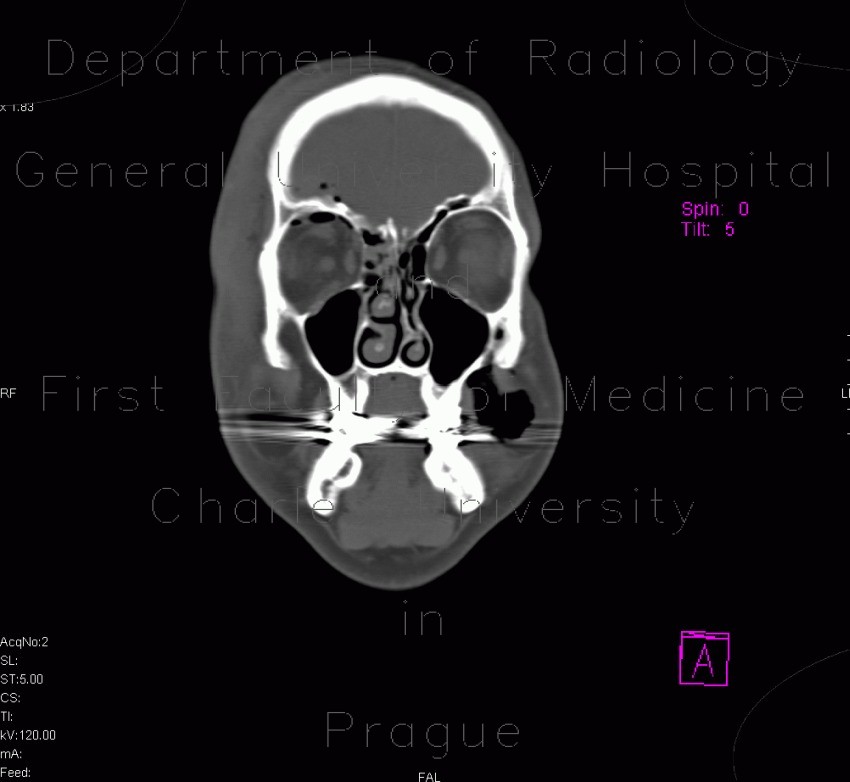 Pneumoorbita