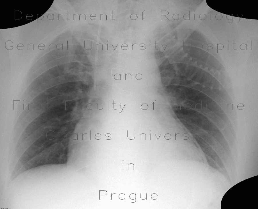 Radiology image - Pneumopericardium, postoperative: Thorax, Heart: X-ray - Plain radiograph