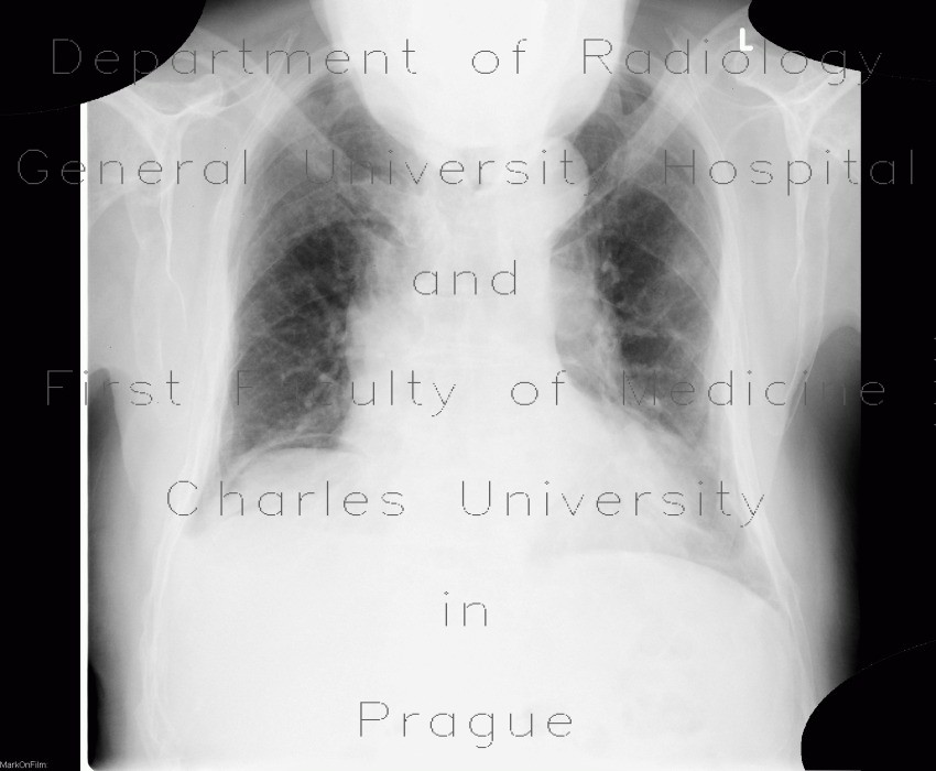 Pneumoperitoneum