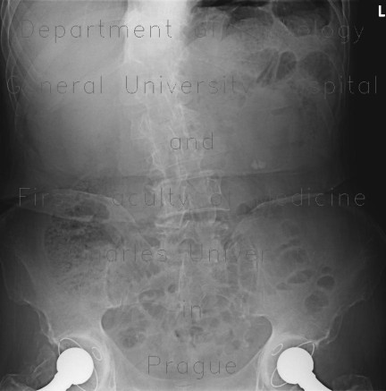 Pneumoperitoneum