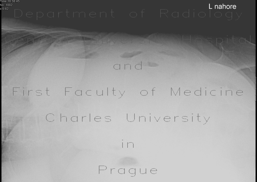 Pneumoperitoneum, lateral radiograph