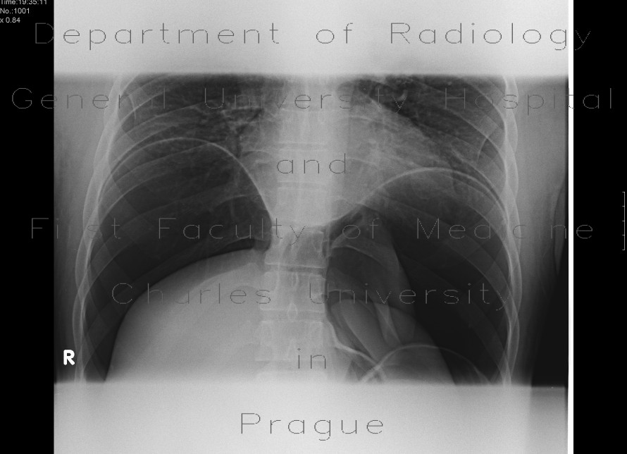 Radiology image - Pneumoperitoneum, massive: Abdomen, Peritoneal cavity: X-ray - Plain radiograph