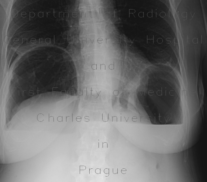 Pneumoperitoneum, massive, ascites