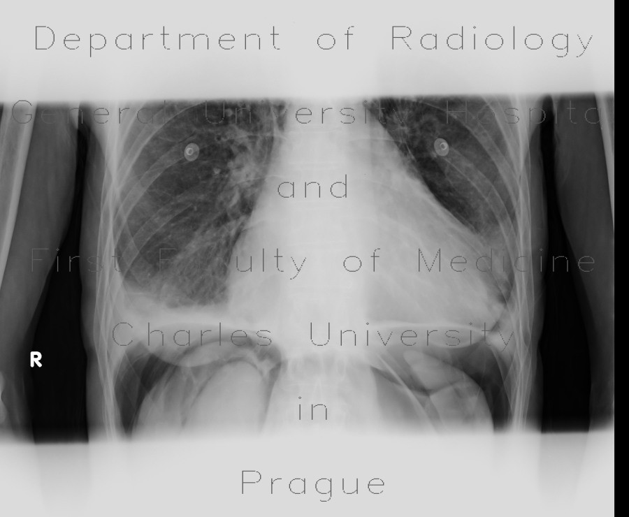 Pneumoperitoneum, pneumoretroperitoneum, massive, air in peritoneal cavity and retroperitoneum