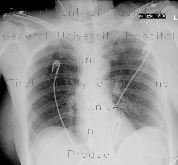 Radiology image - Pneumoperitoneum, postoperative, supine chest radiograph: Abdomen, Peritoneal cavity: X-ray - Plain radiograph