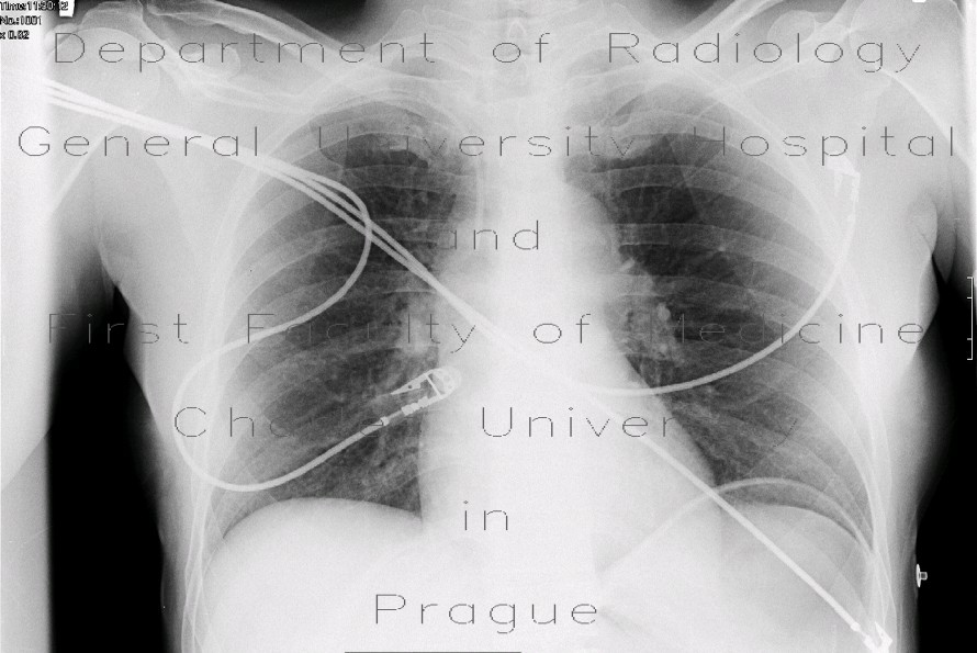 Radiology image - Pneumoperitoneum, postoperatively on supine chest radiograph: Abdomen, Peritoneal cavity: X-ray - Plain radiograph