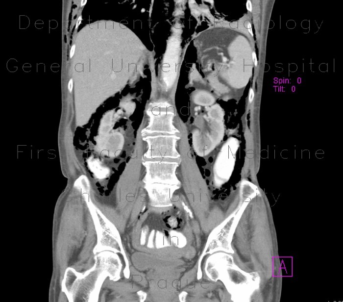 Radiology image - Pneumoretroperitoneum, pneumomediastinum, complication of colonoscopy: Abdomen, Thorax, Large bowel, Mediastinum and pleural cavity, Retroperitoneum, pelvis: CT - Computed tomography