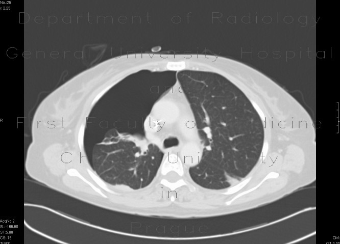 Radiology image - Pneumothorax: Thorax, Lung, Mediastinum and pleural cavity: CT - Computed tomography
