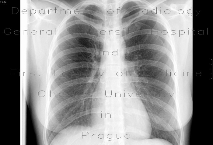Pneumothorax