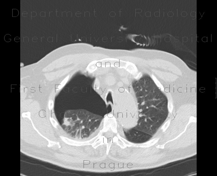 Radiology image - Pneumothorax: Thorax, Lung, Mediastinum and pleural cavity: CT - Computed tomography