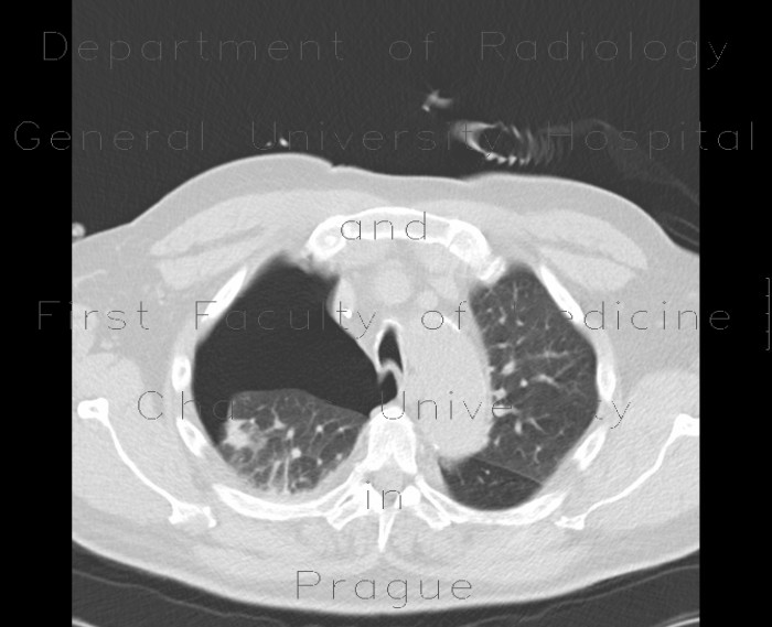 Pneumothorax