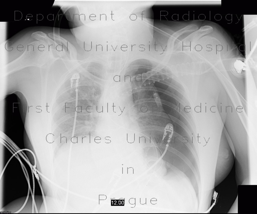 Pneumothorax