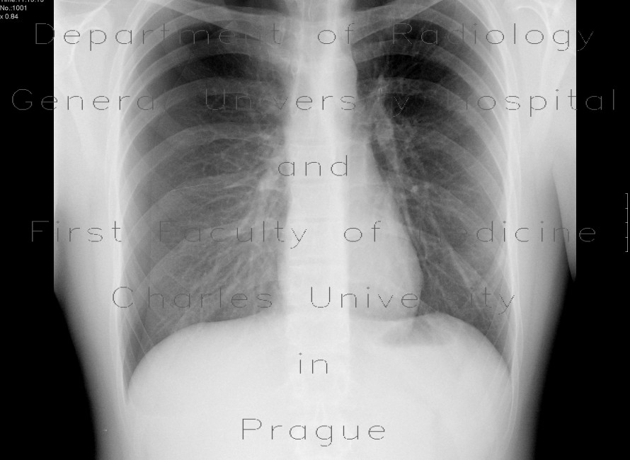 Pneumothorax