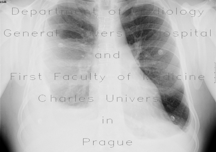 Pneumothorax after evacuation of pleural fluid