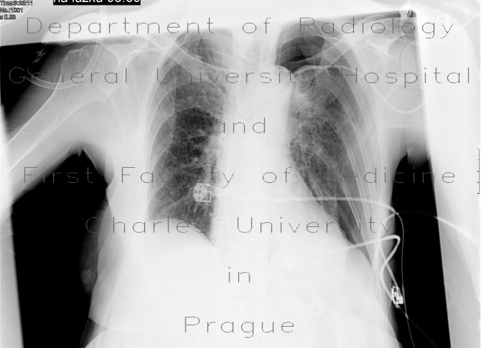 Pneumothorax, complication of central venous line