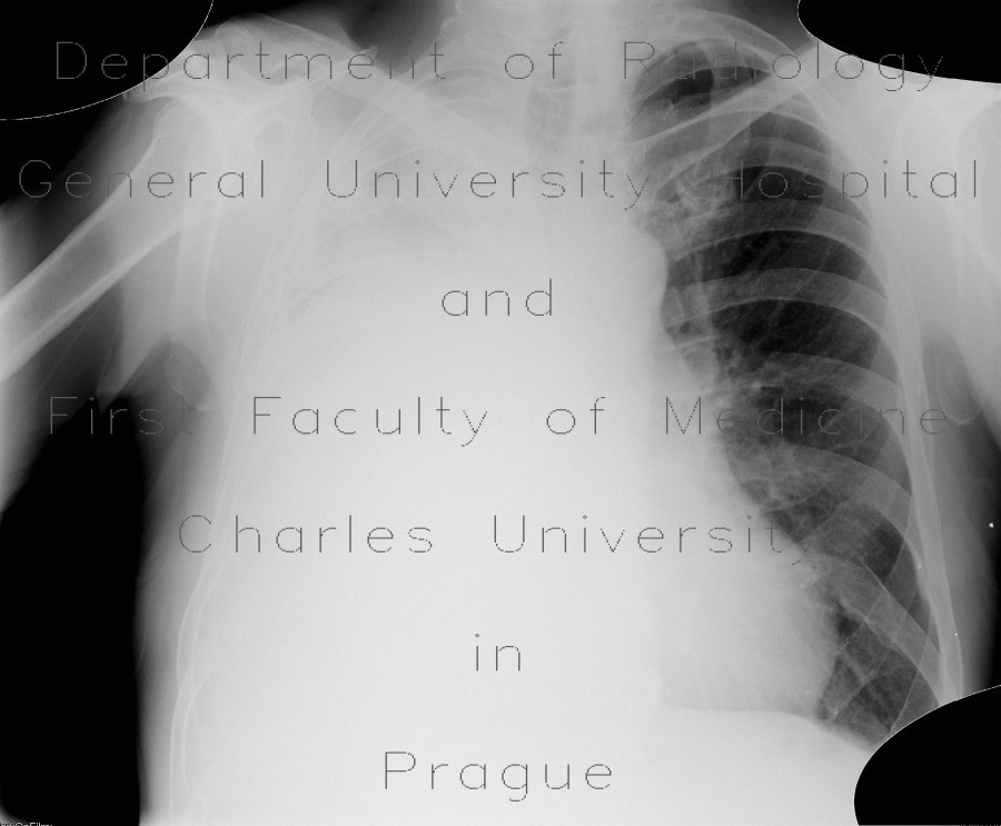 Pneumothorax, fluidopneumothorax, pleural drainage