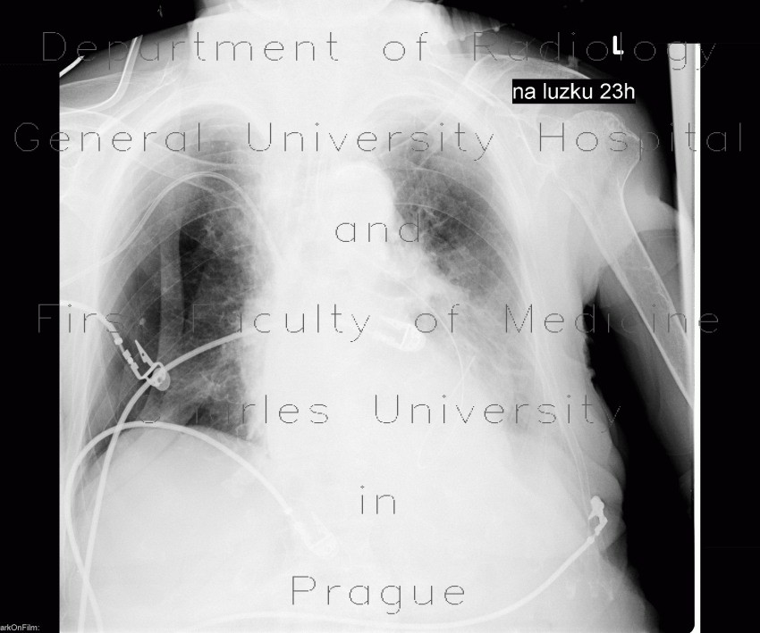 Pneumothorax, malposition of nasojejunal tube
