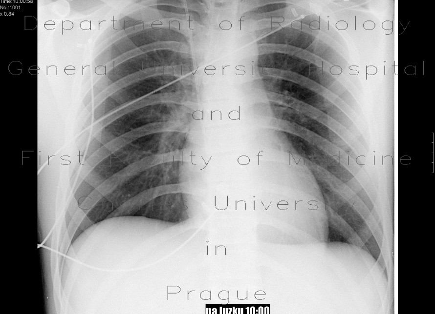 Radiology image - Pneumothorax, small: Thorax, Lung: X-ray - Plain radiograph