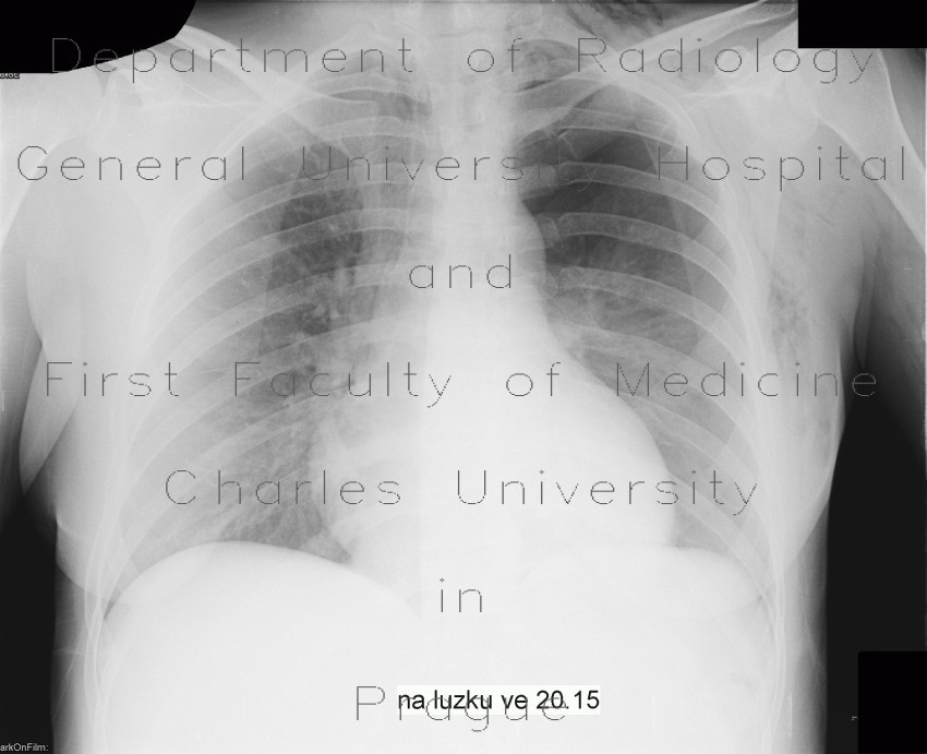 Pneumothorax, subcutaneous emphysema