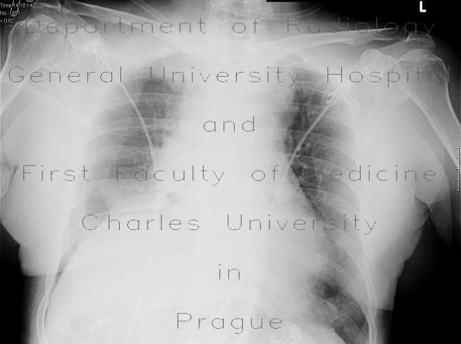 Radiology image - Pneumothorax, supine radiograph: Thorax, Lung, Mediastinum and pleural cavity: X-ray - Plain radiograph