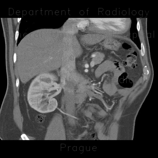 Polar artery, accessory renal artery