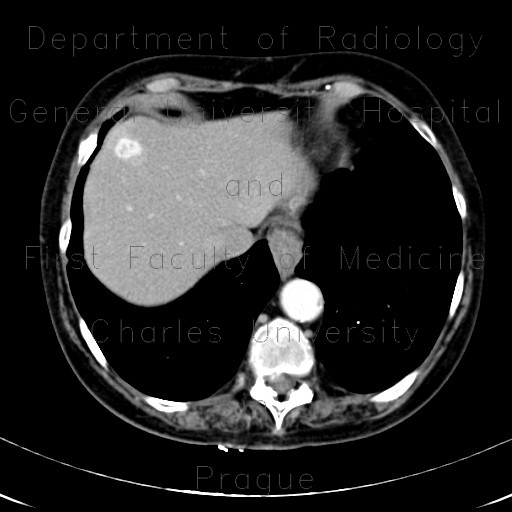 Radiology image - Polycystic kidney, adult polycystic kidney disease, ADPKD, renal carcinoma, liver metastasis, nodal involvement: Abdomen, Kidney and adrenals, Liver: CT - Computed tomography