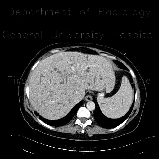 Radiology image - Polycystosis of kidney, adult polycystic kidney disease, ADPKD, liver cysts, Tenckhoff catheter, peritoneal dialysis: Abdomen, Kidney and adrenals, Liver, Peritoneal cavity: CT - Computed tomography