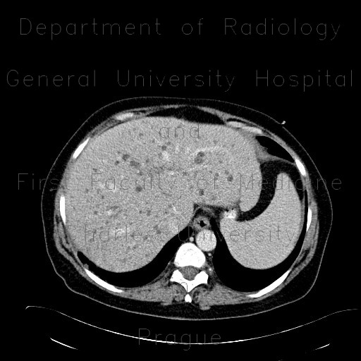 Polycystosis of kidney, adult polycystic kidney disease, ADPKD, liver cysts, Tenckhoff catheter, peritoneal dialysis