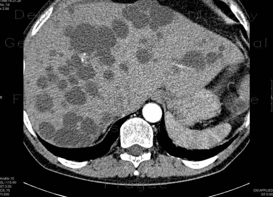 Radiology image - Polycystosis of kidney and liver: Abdomen, Kidney and adrenals, Liver: CT - Computed tomography