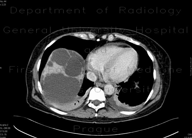 Radiology image - Polycystosis of liver and kidney: Abdomen, Kidney and adrenals, Liver: CT - Computed tomography