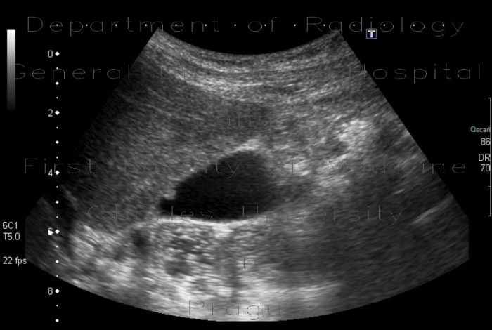 Polyp of gall bladder