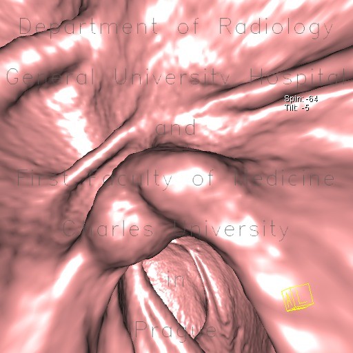 Polyp of hepatic flexure, CT colonography