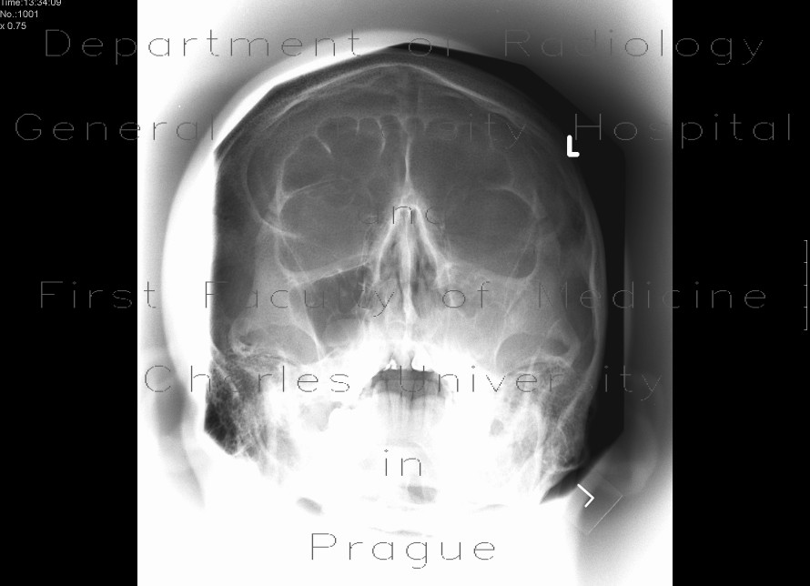 Radiology image - Polyp of maxillary sinus: Head and Neck, Sinuses: X-ray - Plain radiograph