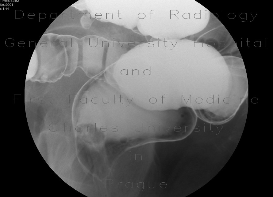 Radiology image - Polyp of rectum, diverticulosis: Abdomen, Large bowel: RF - Fluoroscopy
