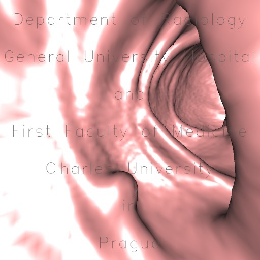 Polyp of sigmoid colon, dimitutive polyp, sessile polyp, CT colonography, VE