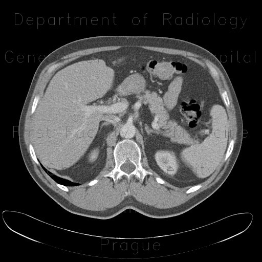 Radiology image - Polyp of transverse colon: Abdomen, Large bowel: CT - Computed tomography