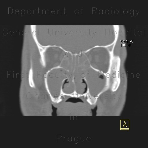 Radiology image - Polyposis of nose and paranasal sinuses: Head and Neck, Sinuses: CT - Computed tomography