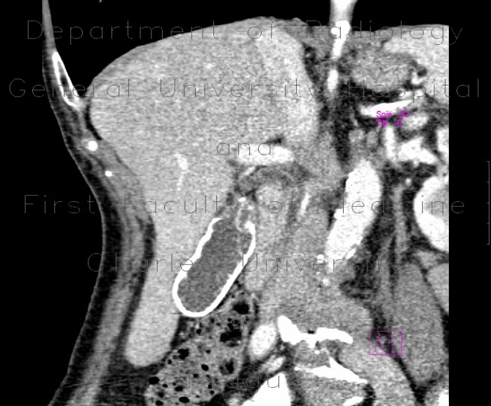 Radiology image - Porcelain gall bladder: Abdomen, Biliary tree: CT - Computed tomography