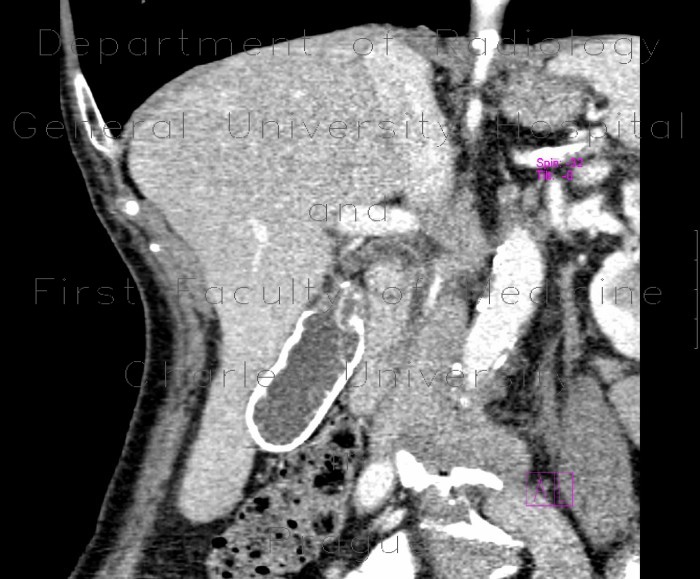 Porcelain gall bladder