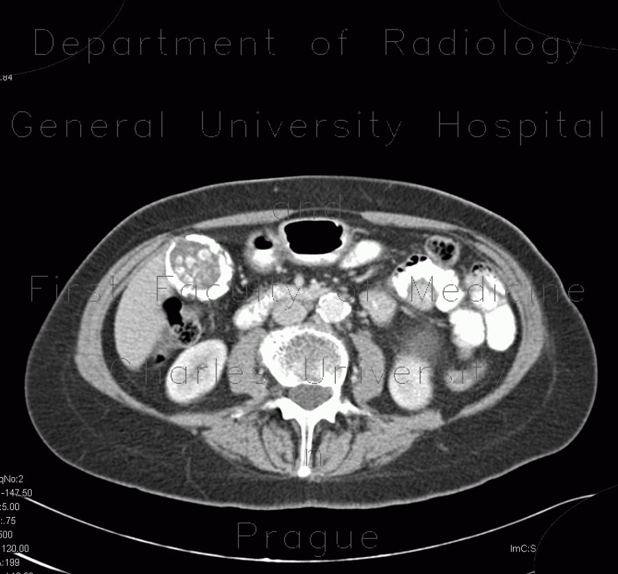 Porcelain gallbladder, calcification of gallbladder, cholecystolithiasis, gallstones