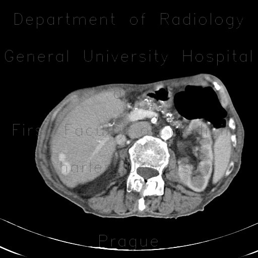 Porto-venous shunt of the liver